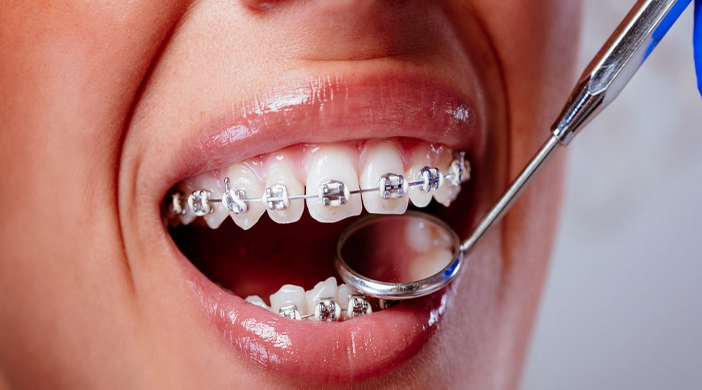 1024x512_0016_checking-braces-2023-11-27-05-01-21-utc