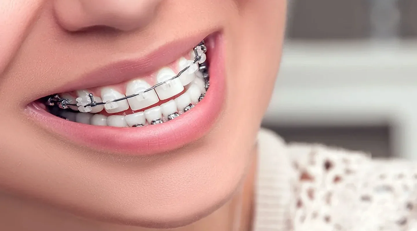 Ceramic-Braces